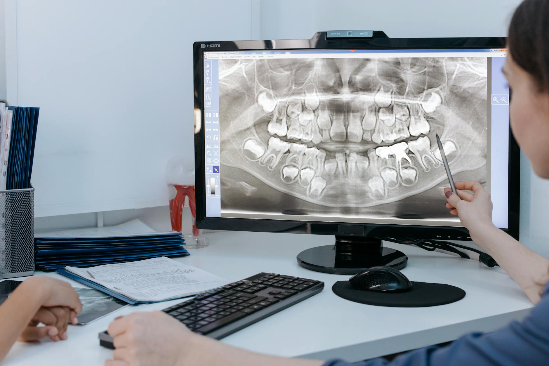 Implantes dentales en España